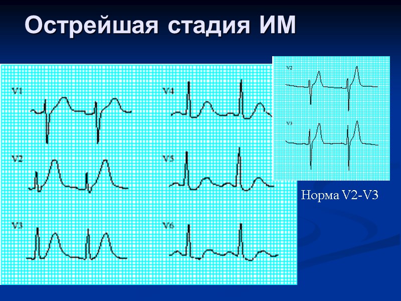 Острейшая стадия ИМ Норма V2-V3